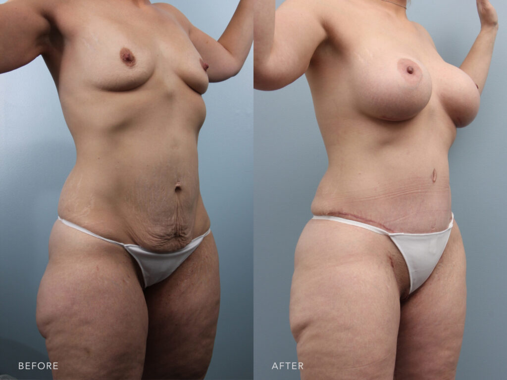 Is a Mommy Makeover Safe?