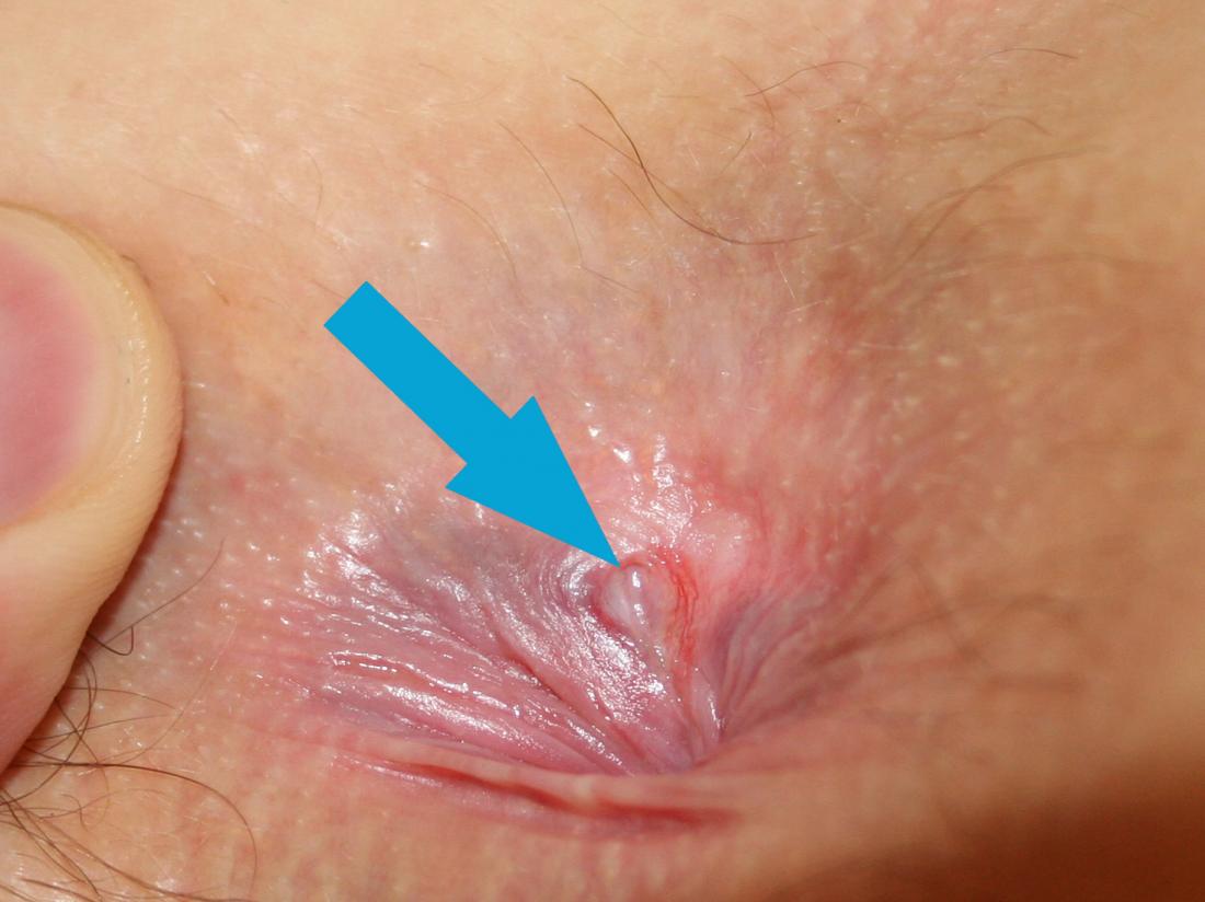 Bump on the anus: 7 causes and their treatments