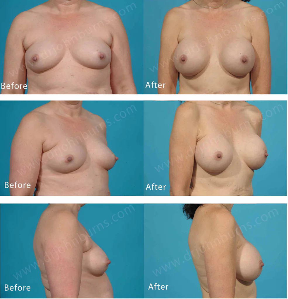 Breast Augmentation: B to C