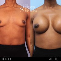 Whats the Difference: Fake Boobs vs. Real Boobs