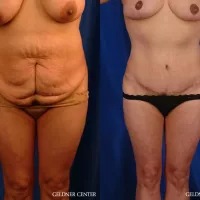 VASER Lipo Before After Gallery