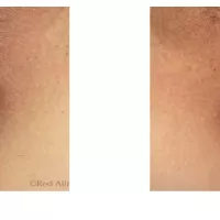 Anal Skin Tags Lake Success Queens Long Island NY