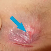 Bump on the anus: 7 causes and their treatments