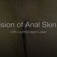 Those Pesky Anal Skin Tags