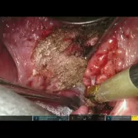 Robotic-assisted Base of Tongue Resection for Adult Sleep Apnea