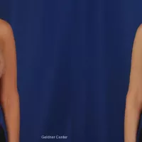 Complex Breast Augmentation Before After Gallery: Patient 10