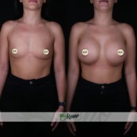Breast Implant Augmentation Turkey