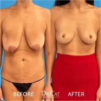 Sagging Breasts: Causes Treatment Options and Solutions