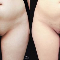 Monsplasty Fupa Reduction Gallery