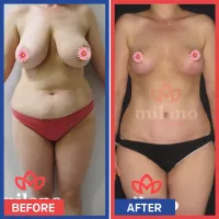 Boob Breast Reduction Surgery Cost in Turkey