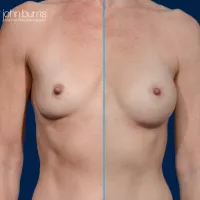 Mini Breast Augmentation