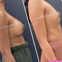 Breast Augmentation Surgeon in Khar West Mumbai