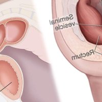 How to Use Prostate Dildo to Achieve Prostate Orgasms