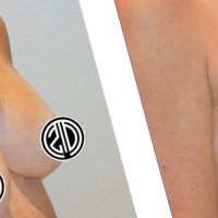 Breast Lift Before and After Photos