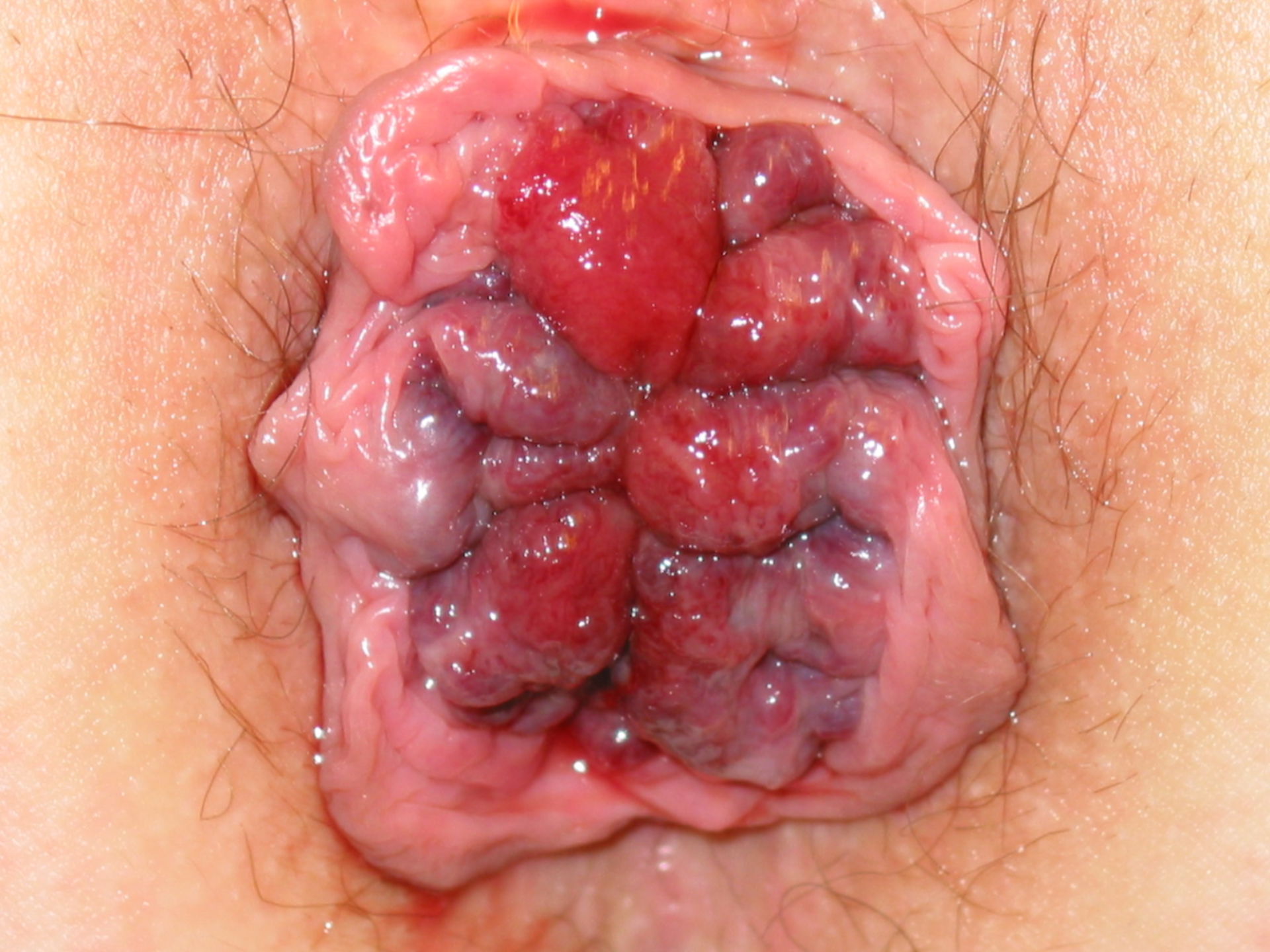 Hemorrhoids grade IV