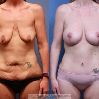 Mommy Makeover Before After Photos Patient 118