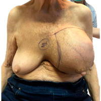 Extremely Rare Type of Breast CancerDedifferentiated Breast LiposarcomaDiagnosis and Treatment
