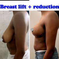 Mastopexy: 4 Facts You Didnt Know About Breast Lift Surgery