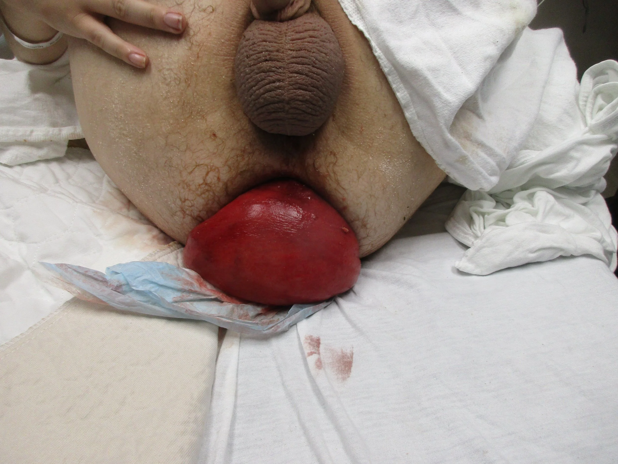 A 25 y.o. male with autism comes in with rectal pain WashU EM Blog