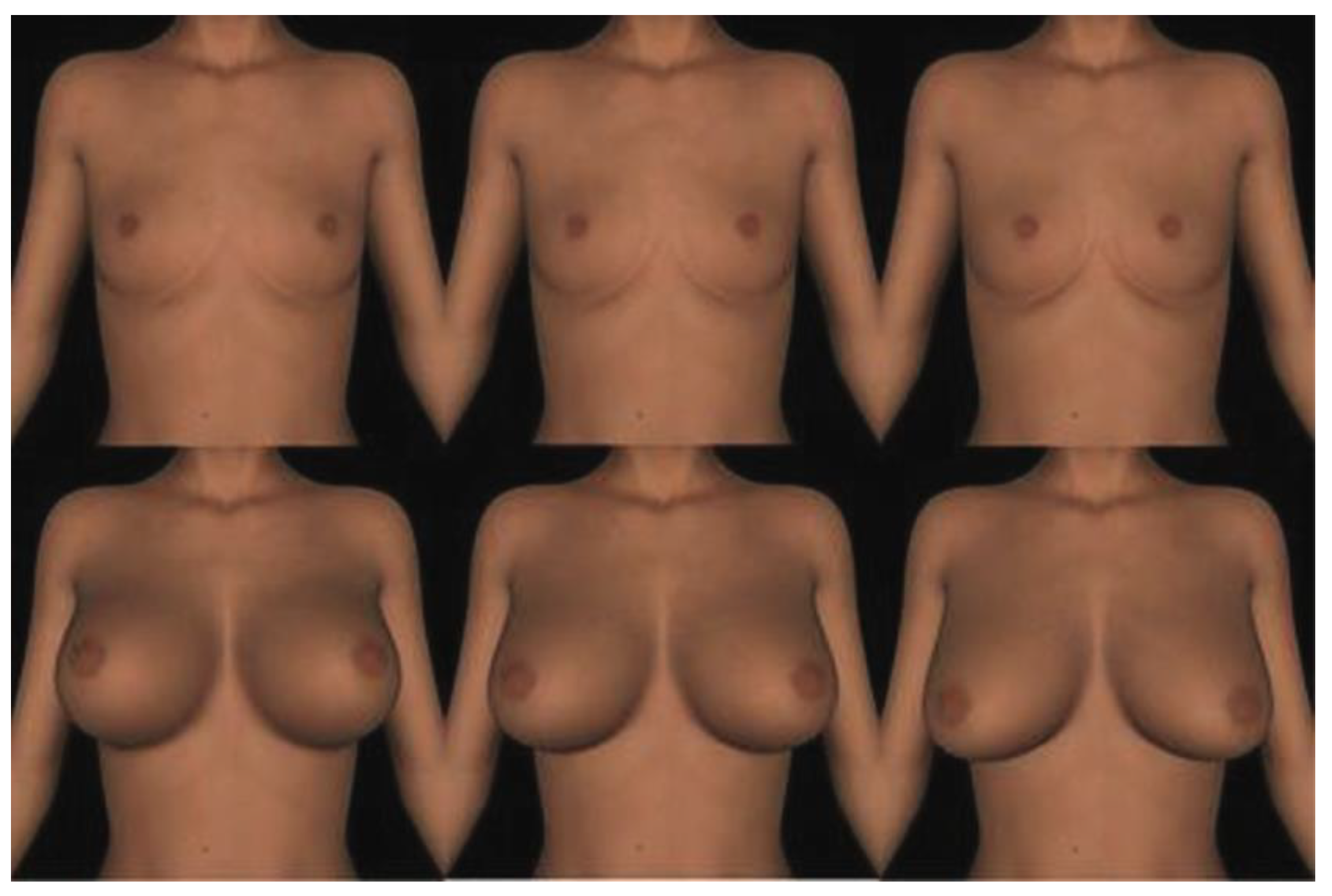 Intrasexual Competition in Womens Likelihood of Self-Enhancement and Perceptions of Breast Morphology: A Hispanic Sample