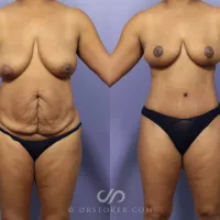 Mommy Makeover Before and After Pictures Case 729