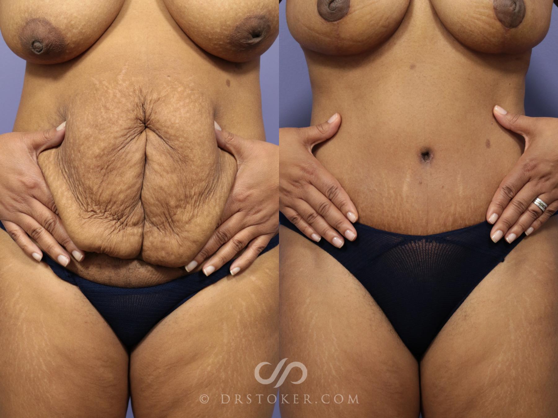Mommy Makeover Before and After Pictures Case 729