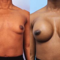 Whats the Difference: Fake Boobs vs. Real Boobs