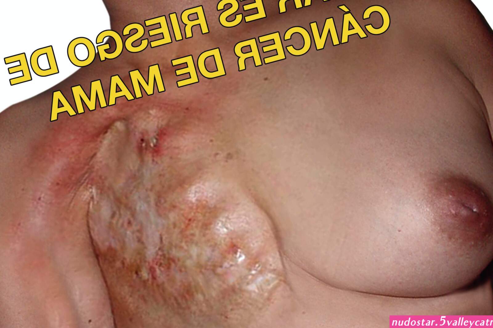 Smoking causes breast cancer